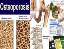 50% Of Indian Population To Be Victims Of Osteoporosis By Next Decade: Report  
