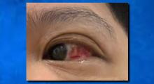 infected eye