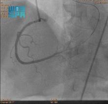 KSrelief Medical Team Saves Life of a Patient with Chronic Obstruction of Right Coronary Artery in Yemen