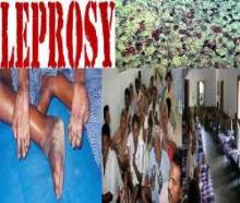 India Accounts For 58% Of Global Leprosy Burden: Report  